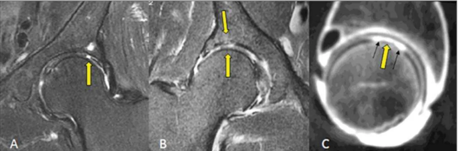 Figure 10. A: Focal and deep chondral erosion with bone exposure and development of subchondral cyst at the acetabular roof