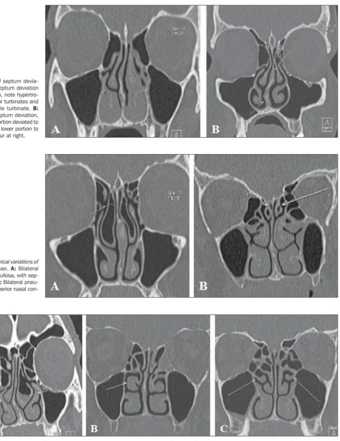 Figure 3. Anatomical variations of the nasal conchae. A: Middle concha bullosa at left, with inflammatory process inside