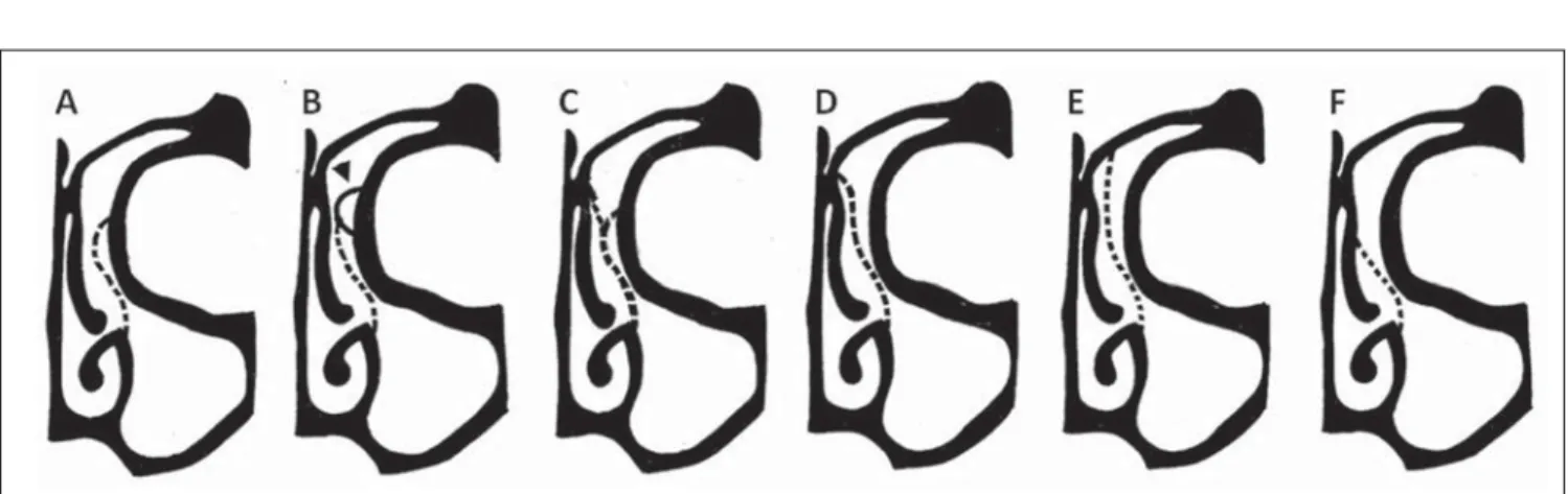 Figure 5. Landsberg &amp; Friedman classification of superior uncinate process insertion