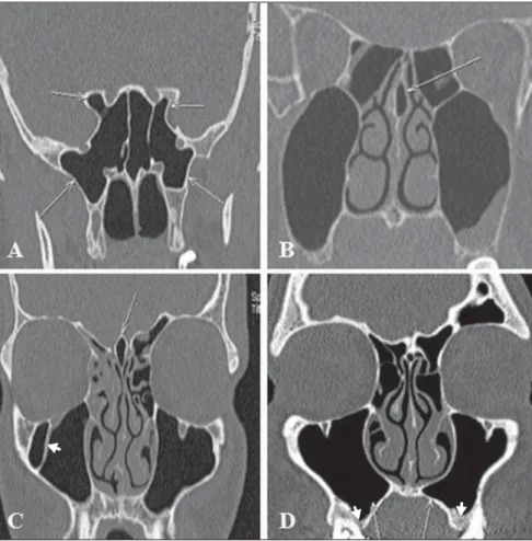 Figure 7. Keros classification. A: Type 1 (lateral cribriform lamella of 1–3 mm, the cribriform plate and the ethmoid cell roof are practically parallel to each other)