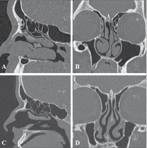 Figure 13. Accessory ostia of maxillary sinuses.