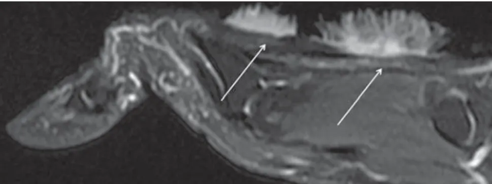Figure 1. Sagittal MRI post-gadolinium T1-weighted image with fat saturation demonstrates two con- con-trast-enhanced superficial lesions (arrows) in the extensor tendons, with no contact to each other.