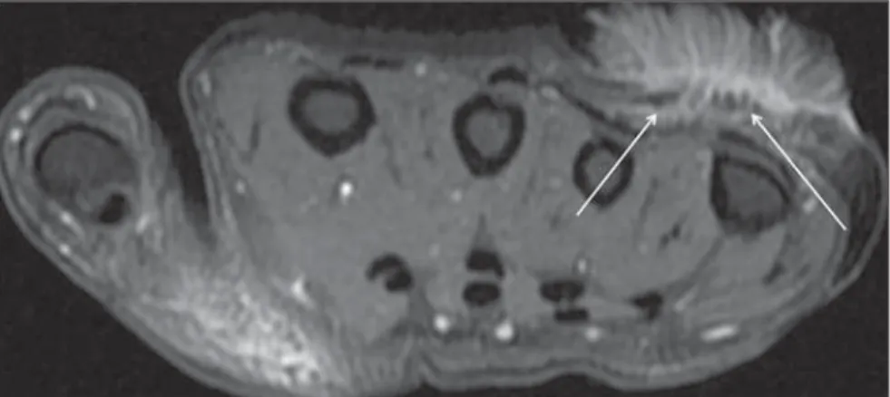 Figure 2. Axial MRI T2-weighted image with fat saturation demonstrates the largest, noninvasive lesion (arrows) in contact with the extensor tendons of the fourth and fifth fingers of the hand.