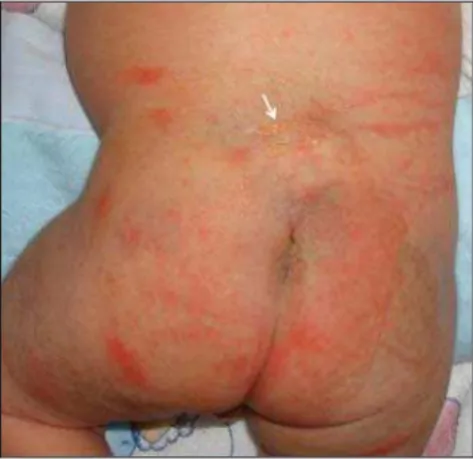 Figure 1. Dorsal dermal sinus. Image of the neo- neo-nate with cutaneous stigmata (arrow) characterized by cutaneous depression covered by a thin  mem-brane located above the intergluteal fold.
