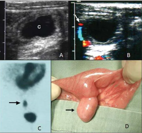 Figure 2. A: Color Doppler US demonstrates a cystic structure in the right lower abdominal quadrant with no sign of mural inflammation