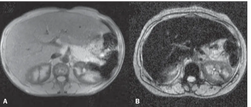 Table 3 MRI sequences weighting and their relationship with two groups (serum ferritin and serum iron).