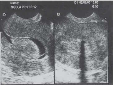 Figure 1. TVUS demonstrating endometrial thickening with variable echo- echo-texture.