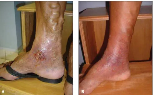 Figure 1. Right lower limb. A: Varices and chronic venous ulcer. B: Healed ulcer and resolution of varicose vein after the procedure..