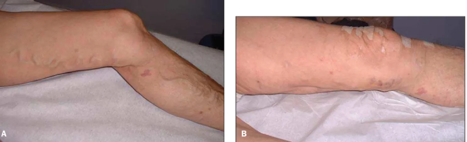 Figure 4. A: Ultrasonography. Echogenic sclerosing agent within the great saphenous vein during application