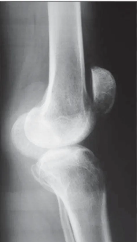Figure 2. Plain radiography lateral view, confirm- confirm-ing knee hyperextension, with a subtle genu  recur-vatum deformity.