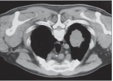 Figure 2. A metal marker is placed on the skin surface and held in position with micropore surgical tape, for the definition of the point of insertion of the needle on a parallel plane and closest to the lesion whenever possible