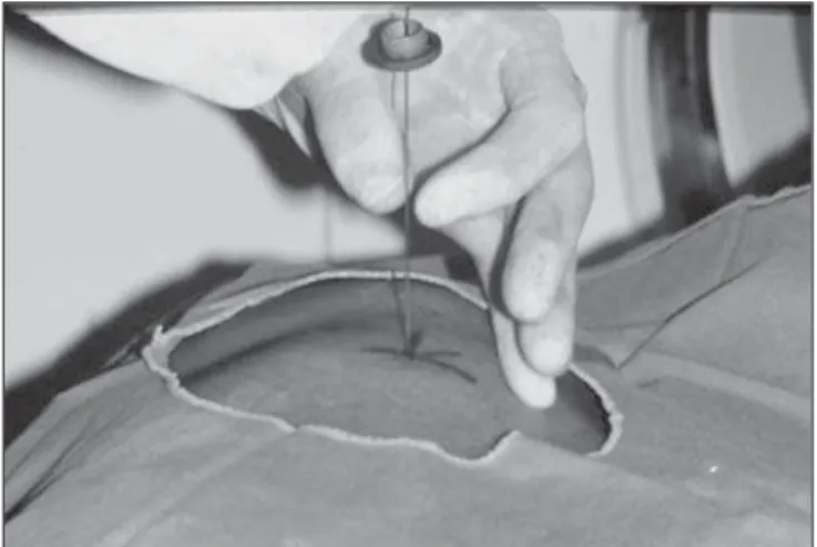Figure 3. After the confirmation of the similarity between the needle course and the distance measured on the computer screen and on the patient’s skin surface, the measurement of the depth required for the needle to reach the lesion and collect the specim
