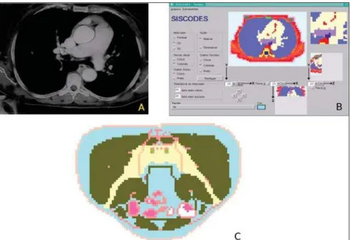 Figure 5. Creation of the thorax voxel model. A: Digitized CT image of the thorax. B: older interface ver- ver-sion of the tissue voxel model of SISCODES, showing the model at the same plane of the image
