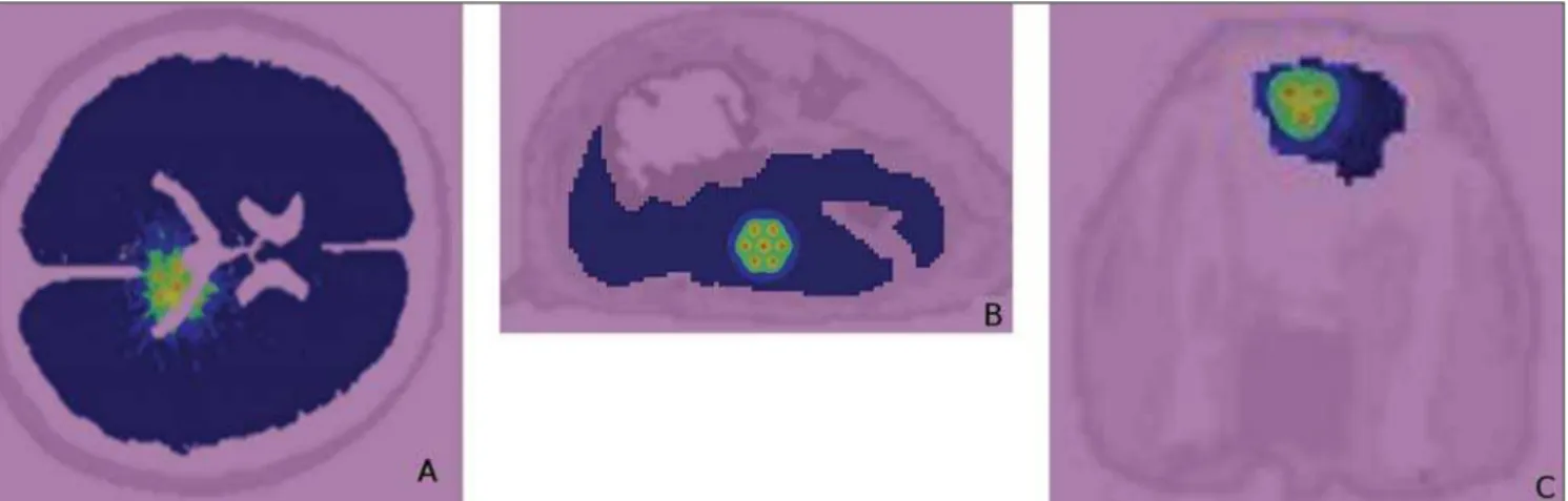 Figure 7. A: Isodoses curves obtained from the simulation of bioglass seeds with Sm-153 implants in a child’s brain
