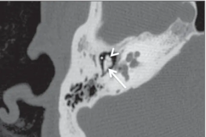 Figure 1. High resolution, axial CT image demonstrating the ice-cream sign of the  tem-poral bone