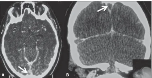 Figure 3. Axial (A) and coronal (B) contrast enhanced CT images of 24-year-old female patient on con- con-traceptive use, with history of headache over the past ten days