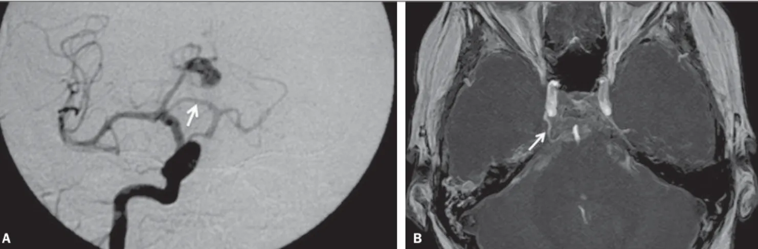 Figure 9. Incidental developmen- developmen-tal venous anomaly found in a digital subtraction angiography of a 40-year-old female patient