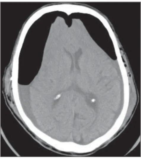 Figure 15. Axial CT image of a 63-year-old patient with a history of traumatic brain injury and bilateral subdural hematomas drainage