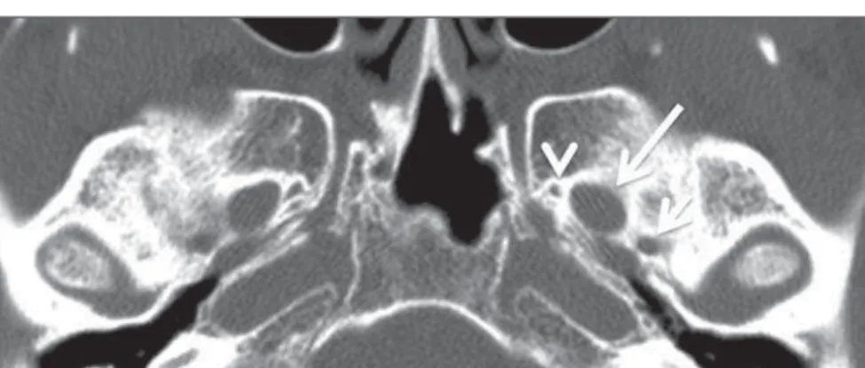 Figure 2. Axial US image of an 18-week-old fetus with spina bifida, at the level of the choroid plexus showing the characteristic lemon sign, secondary to changes in the normal configuration of the  fron-tal bone.