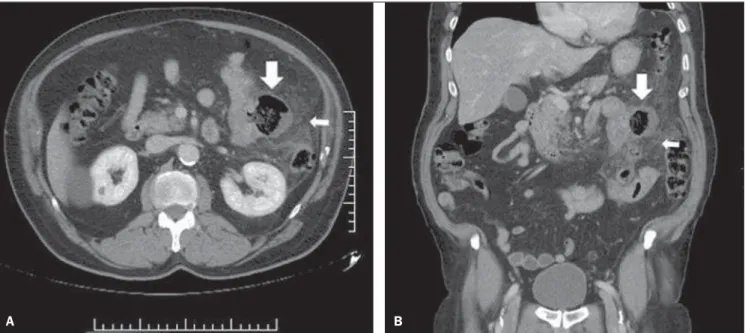 Figure 1. A: Contrast-enhanced axial CT image demonstrating a diverticulum at the mesenteric border of jejunal loop (downwards arrow) and extensive den- den-sification of the adjacent fat (leftwards arrow), signs of acute diverticulitis
