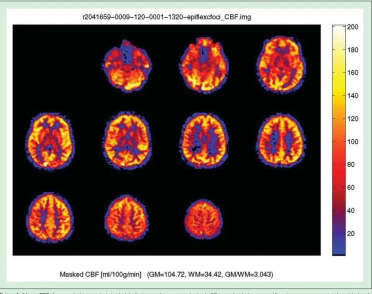 Figura 1. Mapa JPEG de um estudo por arterial spin labeling normal em um paciente de 30 anos de idade, com gráfico de cores representando unidades de ml/100 g de tecido/min