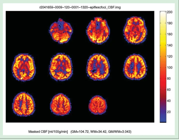Figure 1. Normal arterial spin labeling JPEG map in a 30-year-old male with color ramp representing units of mL/100 g tissue/min