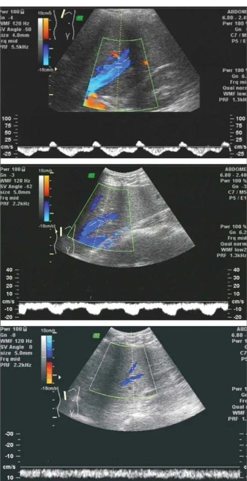 Figure 2. Hepatic vein flow pattern at Doppler. On the upper image, triphasic pattern; on the central image, biphasic pattern; on the lower image, monophasic pattern.
