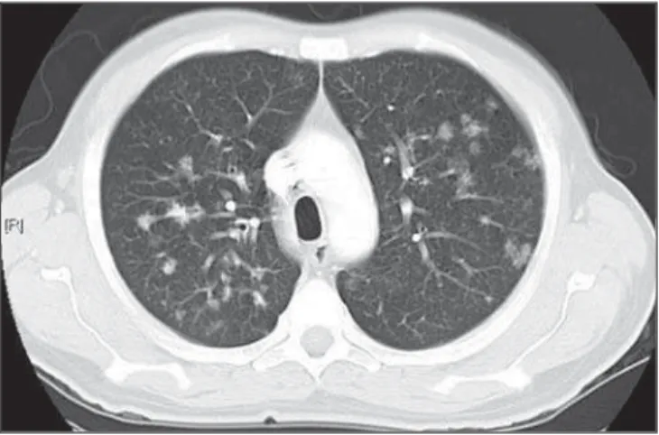 Figure 6. “Tree-in-bud” pattern – Chest CT. Bilateral tubular images in a tree- tree-like branching with minute nodulation at the extremities, most noticeable in the right lung, associated with right-sided small pleural effusion.