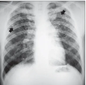 Figure 1. Small rounded opacities (arrows).