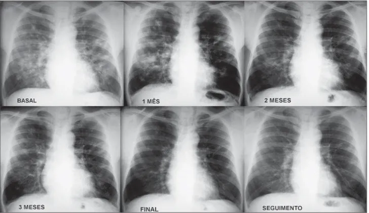 Figure 7. Continuous and gradual improvement in pulmonary radiographic changes in a patient treated with itraconazole.
