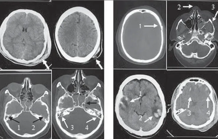 Figure 1. Tomographic patterns. A: Subgaleal hematoma characterized by increase in volume and in the attenuation coefficients of left parietal extracranial soft tissues on both images (arrows)