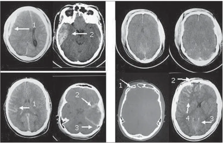 Figure 2. Tomographic patterns. A: Extraparenchymal blood collection characterized by hyperdense concave frontotemporal image (arrow 1) and biconvex right extracerebral temporal image (arrow 2)