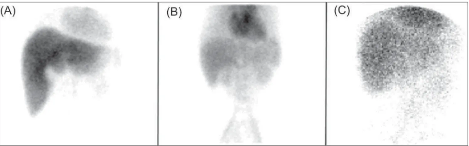 Figure 1. Biliary scintigraphy with the utilization of  99m Tc-DISIDA radiopharmaceutical