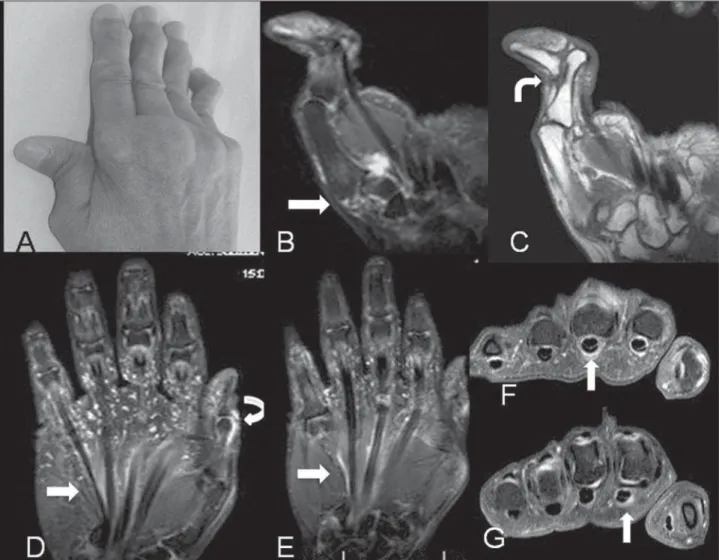 Figure 3. A–C: A 60-year-old female patient diagnosed with SLE for 24 years. Photo and coronal MRI, T2-weighted image with fat suppression and T1-weighted image demonstrating “Z” deformity of thumb with sub-luxation and effusion in the articular interline 