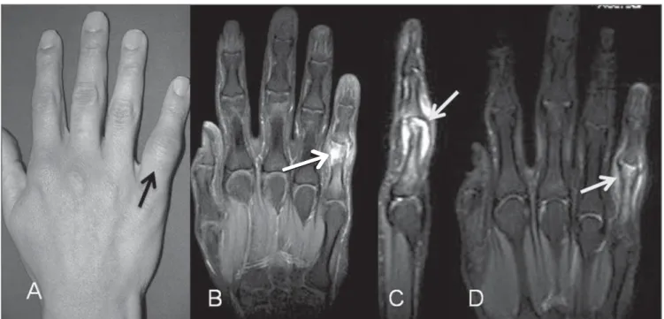 Figure 4. Septic arthritis of proximal interphalangeal joint of the fifth finger. Lupus patient with pain and focal increase in volume (A)