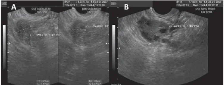 Figure 1. Normal ovaries. A,B: TVUS showing morphologically normal ovaries. On A, technique for measuring ovarian volume.