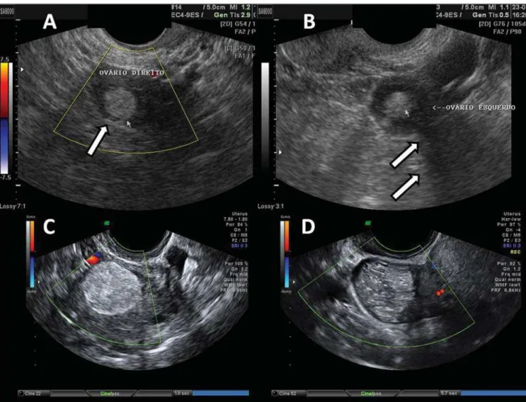 Figure 13. Teratoma. A: Finding of an echogenic fatty mass, with irregular and heterogeneous content, with linear echoes, and without vascularization halos at color Doppler US, in right ovary (arrow)