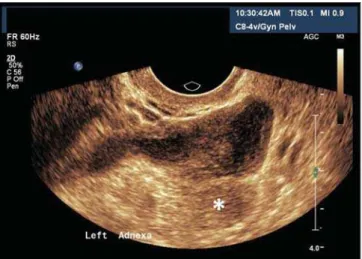 Figure 14. Salpingitis. TVUS demonstrating an echogenic image with tubular shape, adjacent to the ovary (asterisk) with heterogeneous content in its interior
