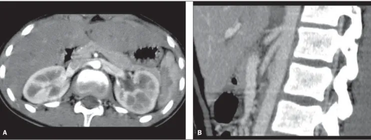 Figure 1. Abdominal MDCT-angiography image in the axial plane (A) and MIP (maximum intensity projection) reformatted image in the sagittal plane (B).