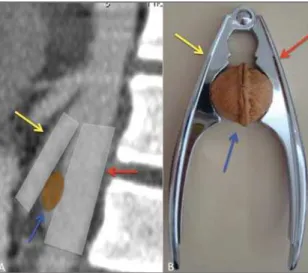 Figure 1. Abdominal MDCT-angiogra- MDCT-angiogra-phy image in the axial plane (A) and MIP (maximum intensity projection)  reformat-ted image in the sagittal plane (B) show compression of left renal vein (LRV)  be-tween the aorta and the superior mesenteric