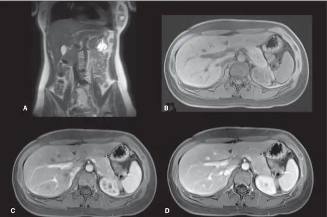 Figure 1. Abdominal region. Coronal T2-weighted single-shot echo-train spin-echo without fat-suppression (A), axial T1-weighted 3D gradient-echo fat-sup- fat-sup-pressed unenhanced (B), and gadolinium-enhanced on hepatic arterial dominant phase (C) and on 