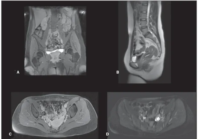 Figure 3. Pelvic region. Gadolinium-enhanced T1-weighted 3D gradient-echo fat-suppressed coronal (A) and axial (C)