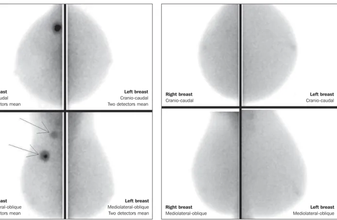 Figure 3. MBI study of a 59-year-old woman with dense breasts whose mam- mam-mogram was inconclusive (BI-RADS 0)