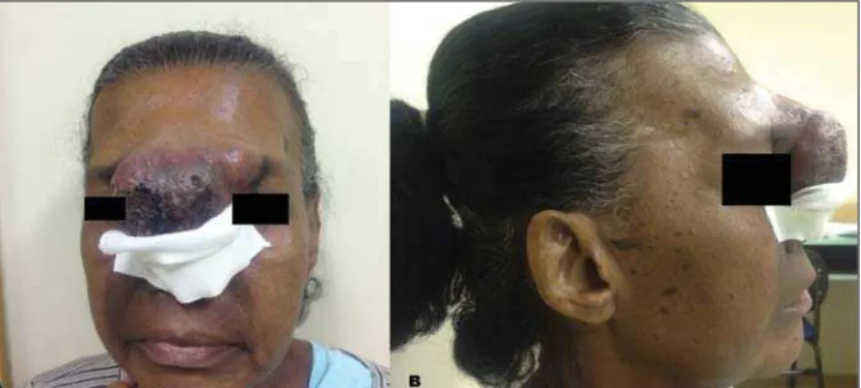 Figure 1. A: Large-sized lesions with epicenter in the glabella, showing a relevant vegetative component associated with ulcerations with necrotic appearance