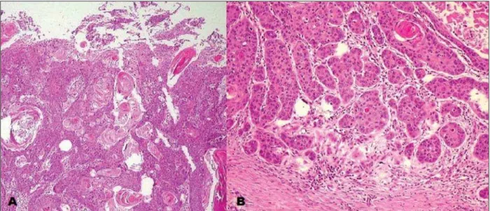 Figure 4. A: Infiltration of the dermis and epidermis by tumor cells with intermingled keratin pearls characteristic of epidermoid carcinoma