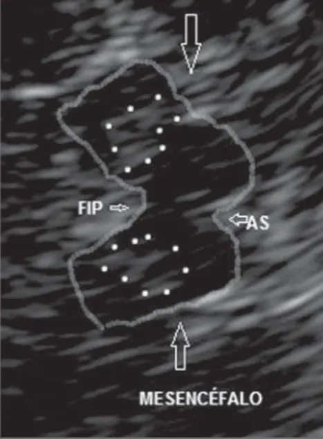 Figure 3. Transcranial sonography – case 3. Right preauricular insonation in a patient with essential tremor