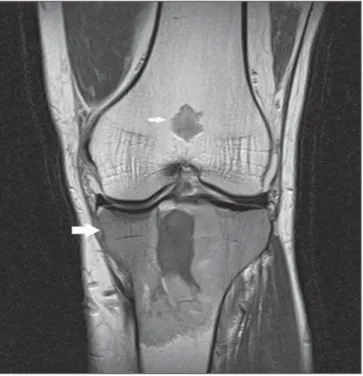 Figure 2. Sagittal MRI T1-weighted image with fat saturation demonstrating neoplastic involvement of osteochondroma (black arrow), intra-articular  com-promise by the tumor (smaller white arrow), as well as lesion extension  to-wards soft tissues (larger w