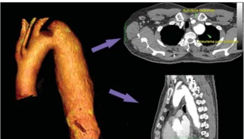 Figure 1. Computed tomography angiography with 3D reformation, and axial and sagittal sections
