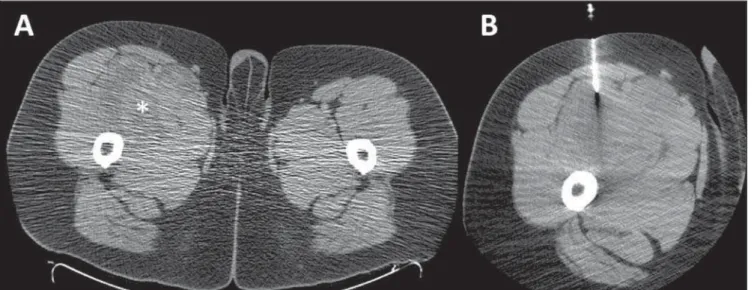 Figure 1. Percutaneous biopsy of an expansile mass in the thigh. A: Axial computed tomography section demonstrating the presence of heterogeneous ill- ill-defined mass in the anteromedial aspect of right thigh (asterisk)