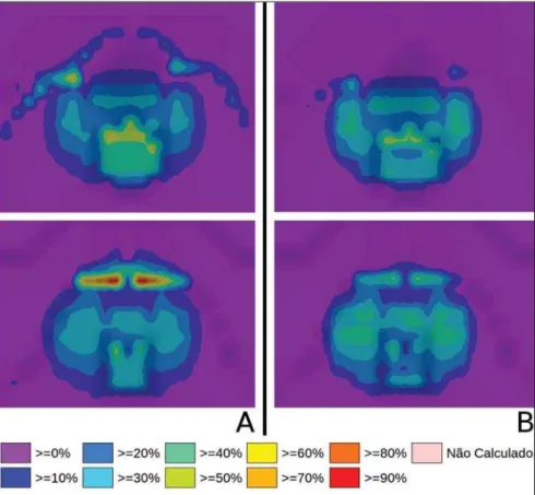 Figure 6A shows high absorbed doses in the soft tissue-bone interface for the  I-125 seed implants